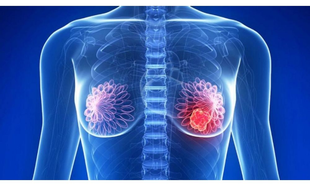 Câncer De Mama Luminal B Tem Cura Descubren una combinación para expandir el uso de la inmunoterapia en